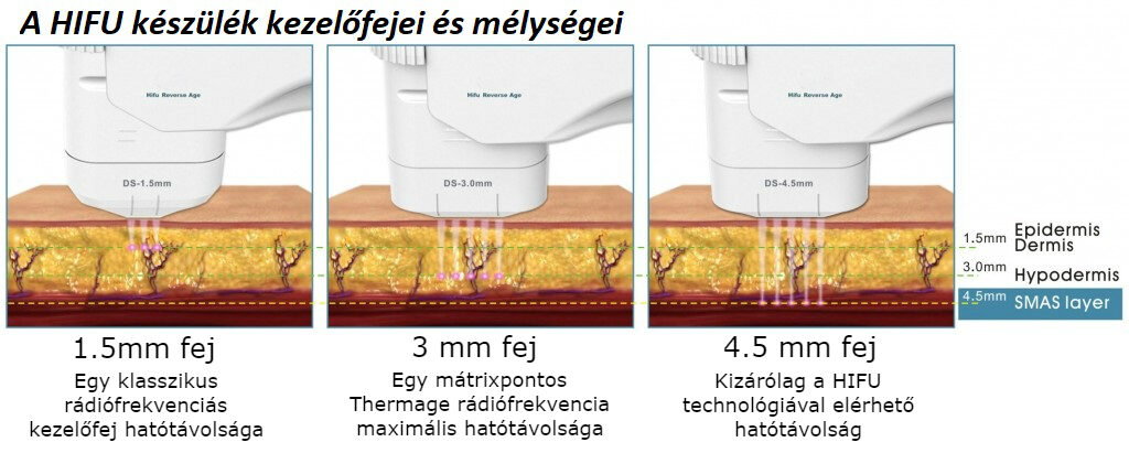 BBS-HIFU kezelőfejek mélységei valamint összehasonlításai egyéb anti-aging technológiák hatákonyságával, bőrfeszesítő hatótávolságával